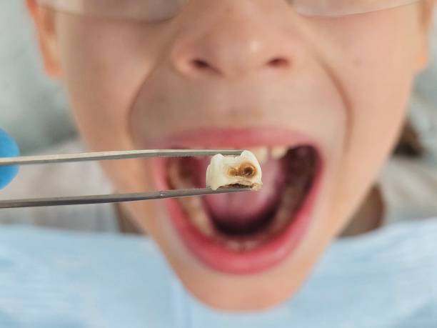 Best Emergency Dental Care for Broken or Chipped Teeth in Kittanning, PA